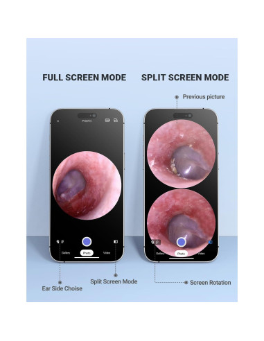 Otoscopio Inalámbrico AnyScope con Cámara y Luz 3.9mm