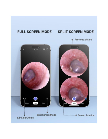 Otoscopio Inalámbrico AnyScope con Cámara y Luz 3.9mm