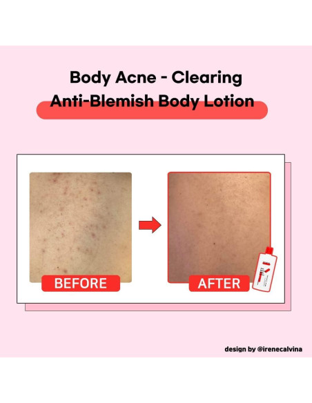 TIA'M Loción Corporal Anti-Manchas 200 ml - Cuidado Acné