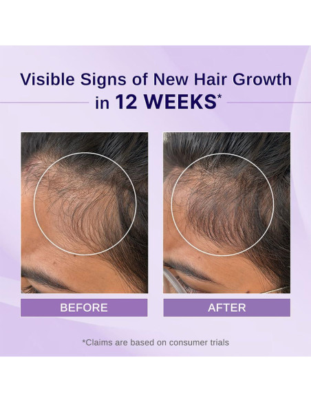 Aceite Crecimiento Capilar Bare Anatomy 100ml Romero Hibisco