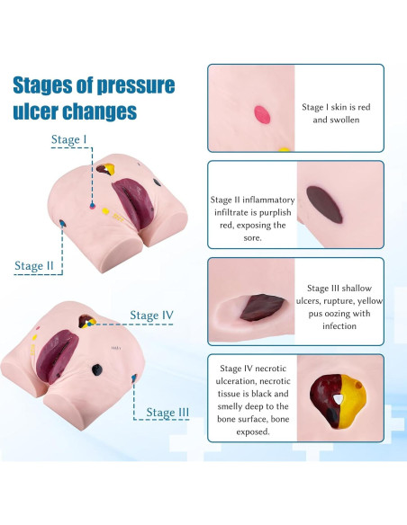 Modelo de Úlcera por Decúbito JNMFTD - 4 Etapas Realistas