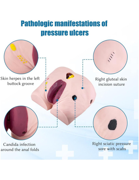 Modelo de Úlcera por Decúbito JNMFTD - 4 Etapas Realistas