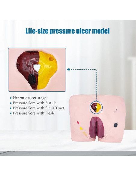 Modelo de Úlcera por Decúbito JNMFTD - 4 Etapas Realistas