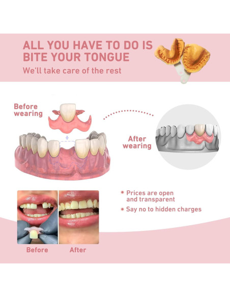 Dentadura Parcial Personalizada Mevivism para 1 Diente - Ajuste Cómodo