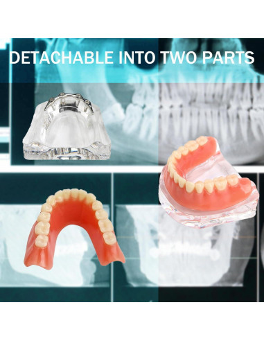 Modelo Dental Sobredentadura Desmontable Kouyot - Mandíbula Inferior