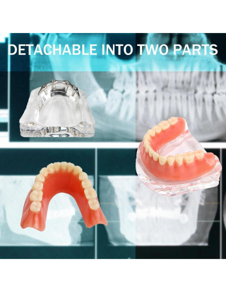 Modelo Dental Sobredentadura Desmontable Kouyot - Mandíbula Inferior