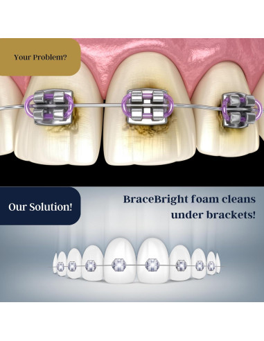 Kit de Blanqueamiento Dental BraceBright para Frenos - Sin Sensibilidad