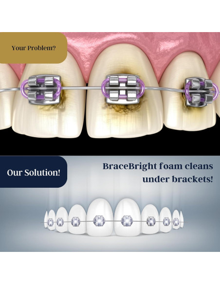 Kit de Blanqueamiento Dental BraceBright para Frenos - Sin Sensibilidad