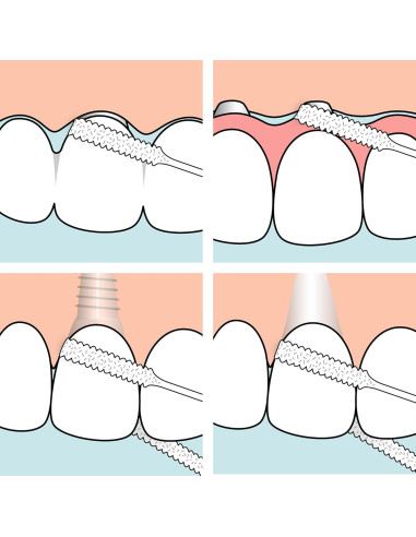 Hilo Dental TePe para Puentes e Implantes - 30 Piezas