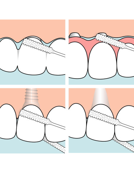 Hilo Dental TePe para Puentes e Implantes - 30 Piezas