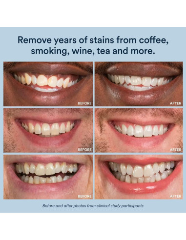 Kit de Blanqueamiento Dental Auraglow LED + Gel 44%