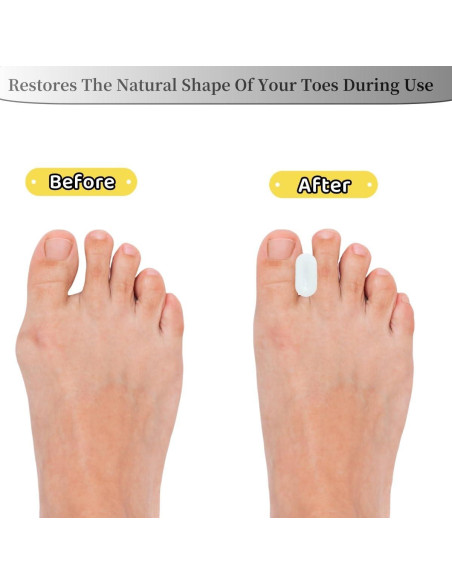 Separadores de Dedos de Gel Dlosn - 12 Paquetes para Alivio de Juanetes