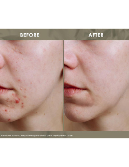 Aceite Esencial Facial Clear Acne Redmint 20ml - Natural y Orgánico