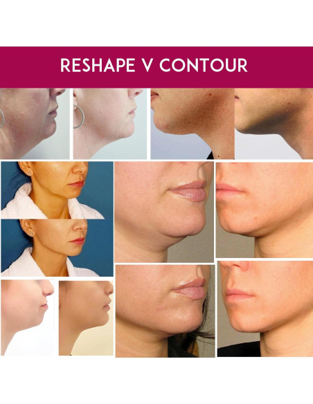 Máscara Reafirmante para Cuello y Barbilla Anacis - 5 Unidades