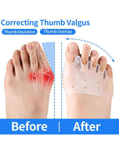 Separadores de Dedos Puoposty para Juanetes y Dedo en Martillo - 8 Pcs