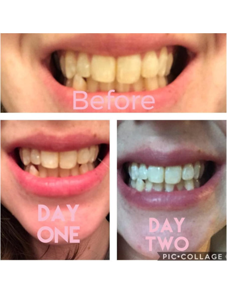 Kit de Blanqueamiento Dental Smile Titan con Luz LED - 5 Piezas