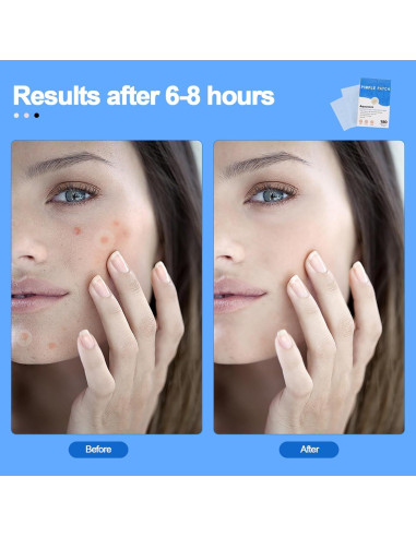 Parche Invisible para Acné Aquuaera - 180 Unidades Hidrocoloide