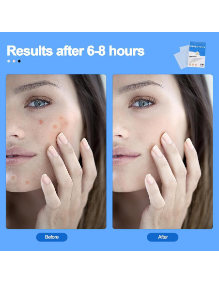 Parche Invisible para Acné Aquuaera - 180 Unidades Hidrocoloide Parche Invisible para Acné Aquuaera - 180 Unidades Hidrocoloide