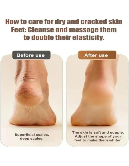 Removedor de Callos Eléctrico Morningso Negro Recargable USB