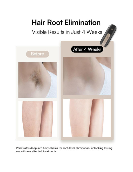 Depilador Láser INIA Fond para Cuerpo y Cara, 5 Niveles