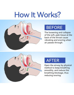 Clip Nasal Anti Ronquidos Anngola - 10 Paquetes Efectivos 2