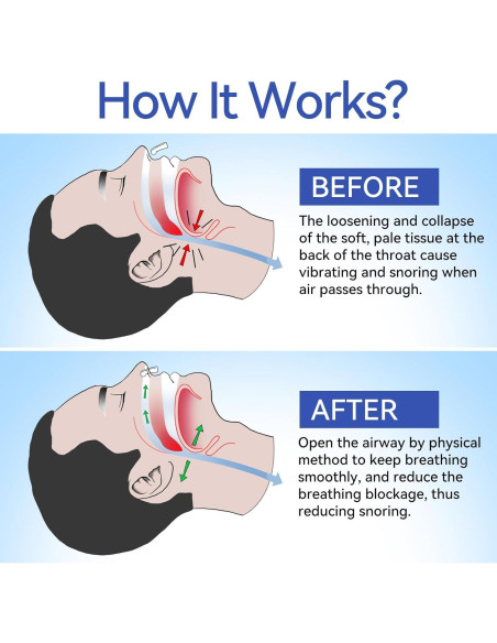 Clip Nasal Anti Ronquidos Anngola - 10 Paquetes Efectivos