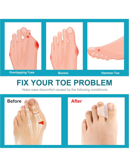 6 Piezas Corrector de Dedo en Martillo Sopoloray Pequeño