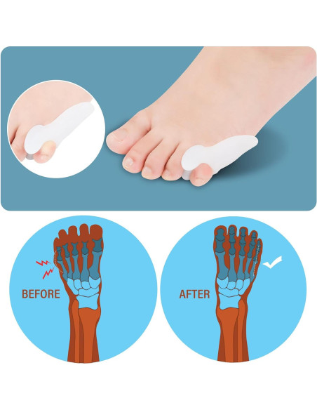 Separador de Dedo Meñique DYKOOK 6 Piezas Gel Alivio Dolor
