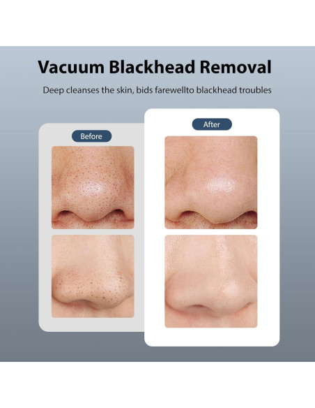 Removedor de Puntos Negros ViQure Hydrafacial 5 en 1
