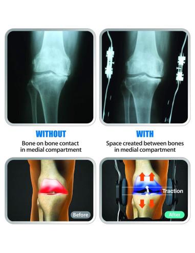 Rodillera Descargadora DDS, Inc. OA Pro - Estabilidad Medial y Lateral (Pequeña)