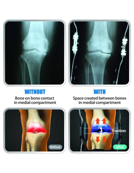 Rodillera Descargadora DDS, Inc. OA Pro - Estabilidad Medial y Lateral (Pequeña)