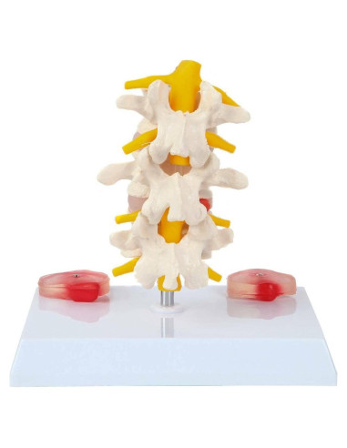 Modelo de Vérttebras Lumbar Axis Scientific con Discos Prolapsados