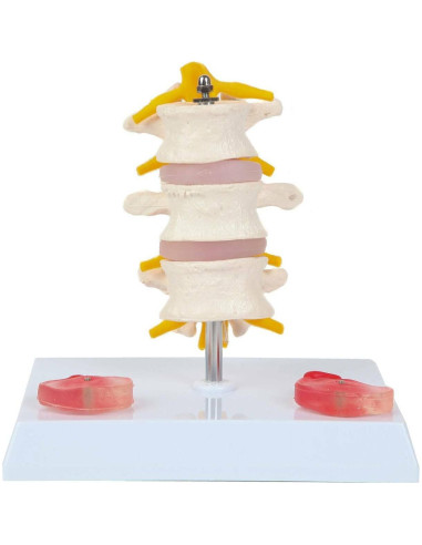 Modelo de Vérttebras Lumbar Axis Scientific con Discos Prolapsados