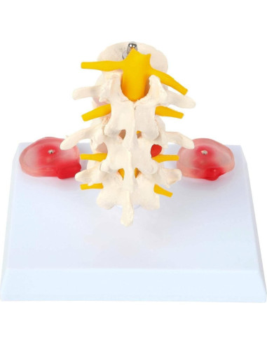 Modelo de Vérttebras Lumbar Axis Scientific con Discos Prolapsados