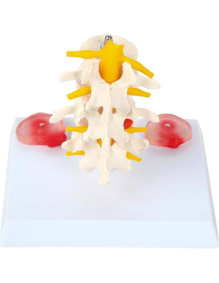 Modelo de Vérttebras Lumbar Axis Scientific con Discos Prolapsados