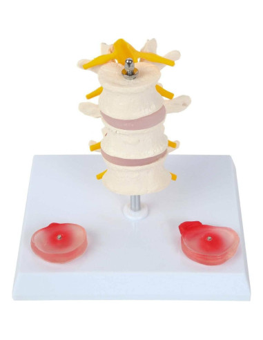 Modelo de Vérttebras Lumbar Axis Scientific con Discos Prolapsados