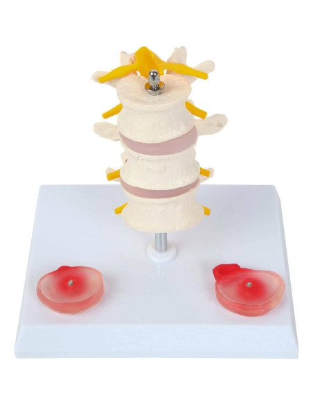 Modelo de Vérttebras Lumbar Axis Scientific con Discos Prolapsados