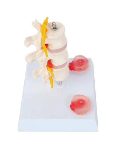Modelo de Vérttebras Lumbar Axis Scientific con Discos Prolapsados