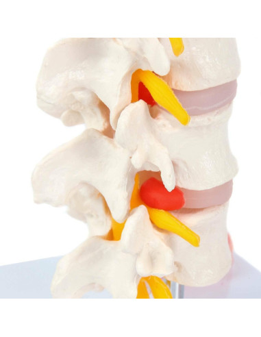 Modelo de Vérttebras Lumbar Axis Scientific con Discos Prolapsados