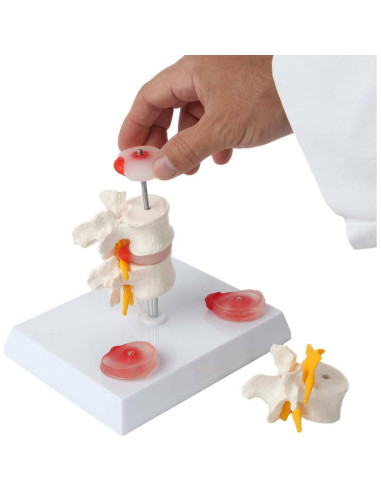 Modelo de Vérttebras Lumbar Axis Scientific con Discos Prolapsados