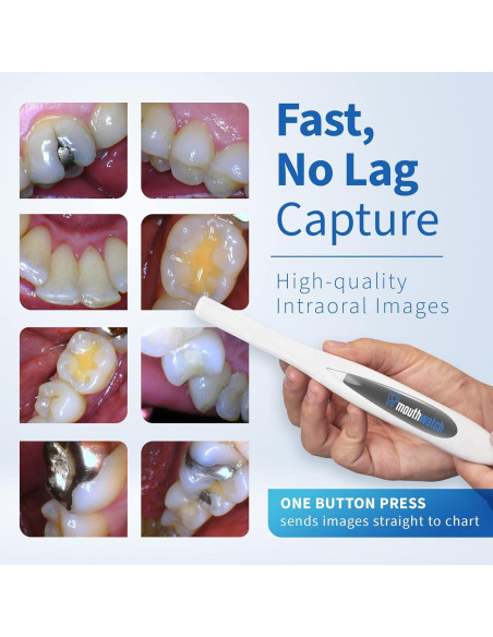 Cámara Intraoral Digital MouthWatch 1 - Imágenes Claras y Rápidas