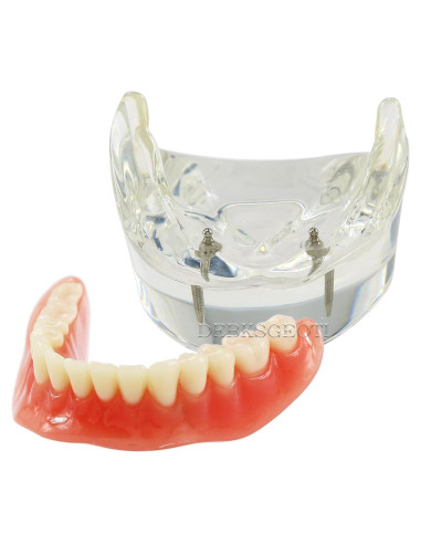 Modelo Dental Typodont M6002 con Sobredentadura y 2 Implantes