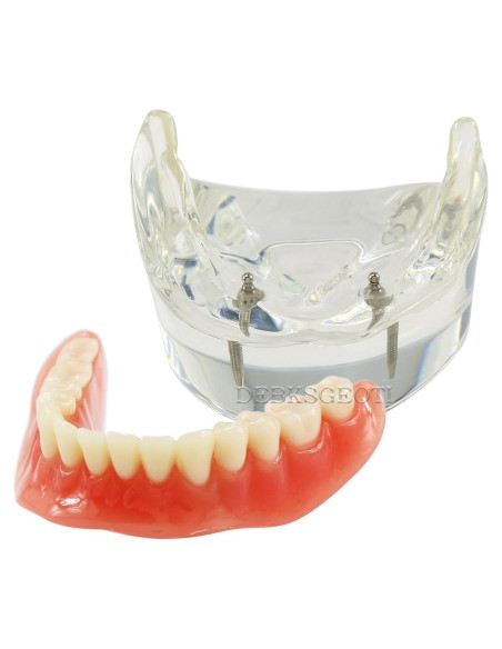 Modelo Dental Typodont M6002 con Sobredentadura y 2 Implantes
