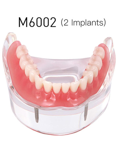 Modelo Dental Typodont M6002 con Sobredentadura y 2 Implantes