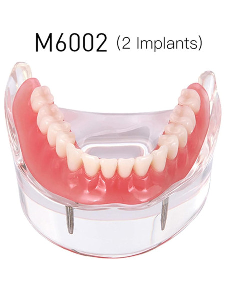 Modelo Dental Typodont M6002 con Sobredentadura y 2 Implantes