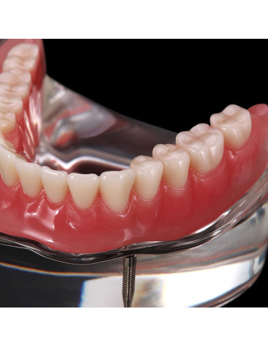 Modelo Dental Typodont M6002 con Sobredentadura y 2 Implantes