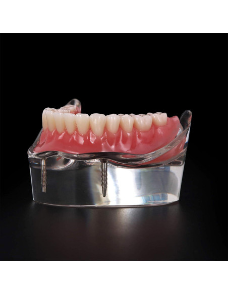 Modelo Dental Typodont M6002 con Sobredentadura y 2 Implantes