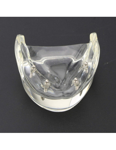 Modelo Dental Typodont M6002 con Sobredentadura y 2 Implantes