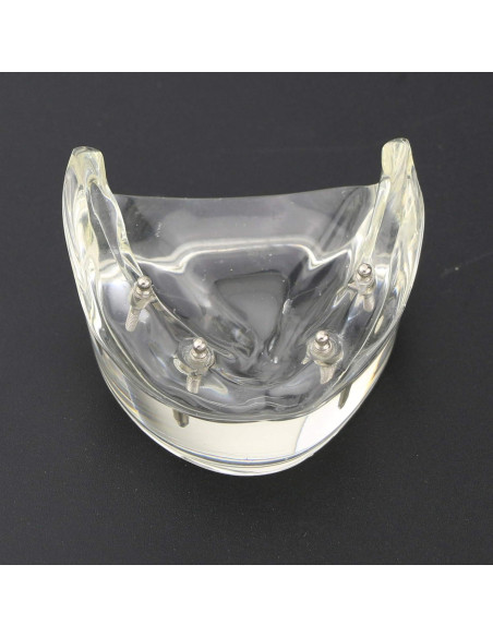 Modelo Dental Typodont M6002 con Sobredentadura y 2 Implantes