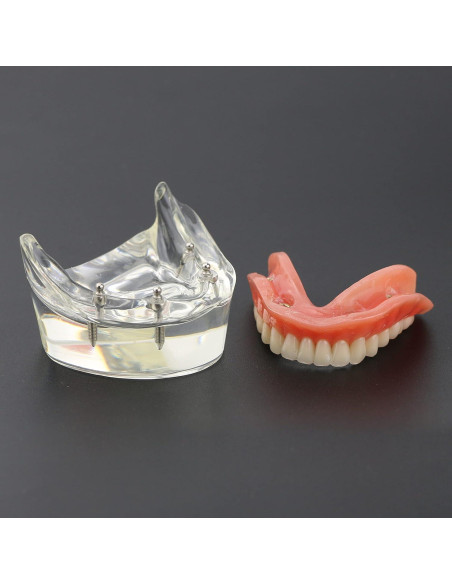 Modelo Dental Typodont M6002 con Sobredentadura y 2 Implantes